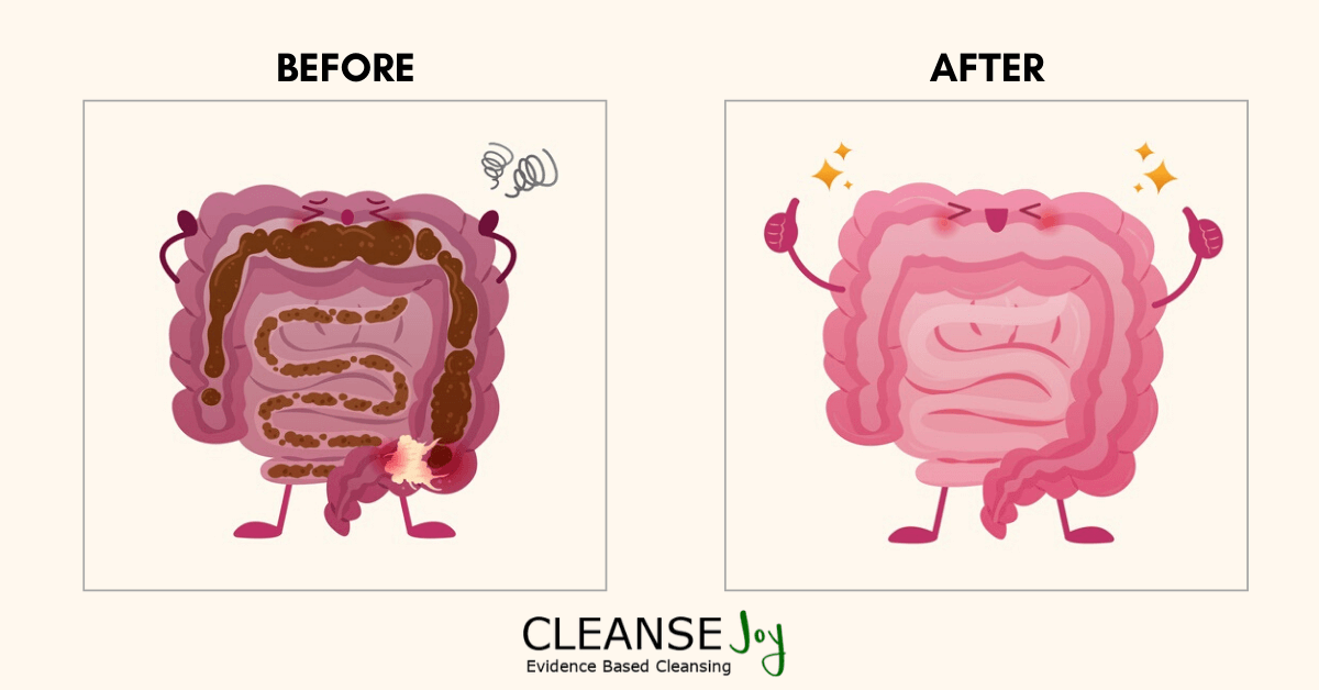 How To Clean Out Bowels Quickly Before and After